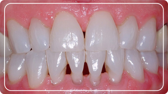 Diş Eti Çekilmesi ⋆ Diş Estetiği Gülüş Estetiği