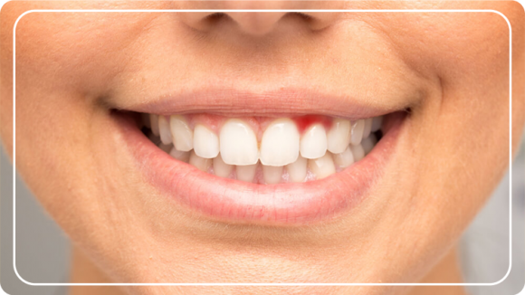 Diş Eti Tedavisi Bitkisel ⋆ Diş Estetiği Gülüş Estetiği